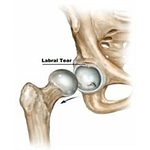labral tear hip treatment