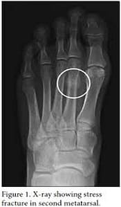 Stress Fracture2