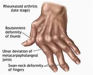 Rheumatoid Arthritis Hand