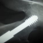 Orthopedic Implants