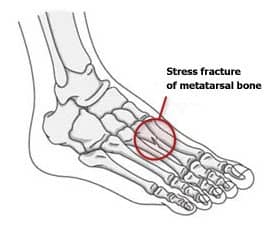 Stress Fracture1