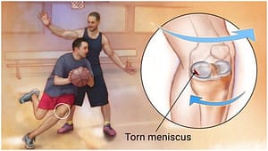 Meniscus Tear1
