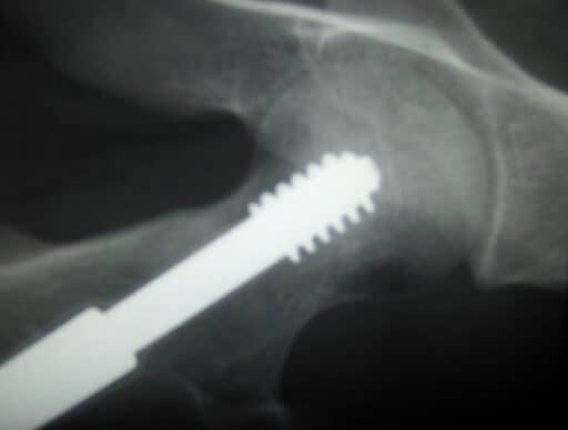 Orthopedic Implants