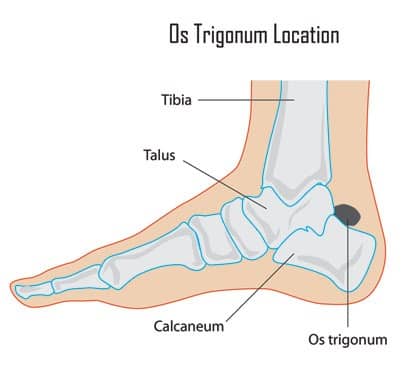 Posterior Impingement (Os Trigonum Syndrome) | Pain Free Physiotherapy